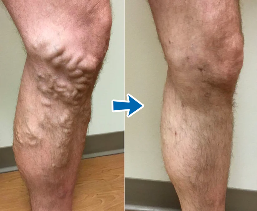 Cvreoz® VenoAid Varizen-Lösungsspray PRO