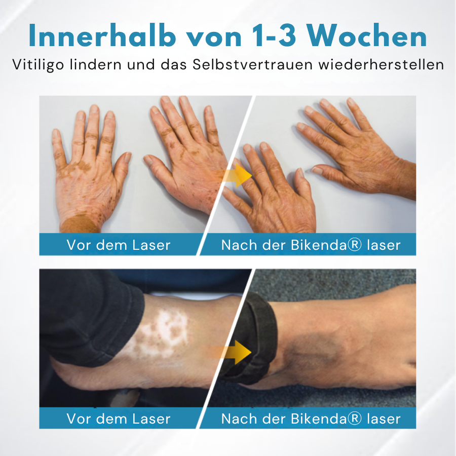 Bikenda® Vitiligo-Lichttherapiegerät