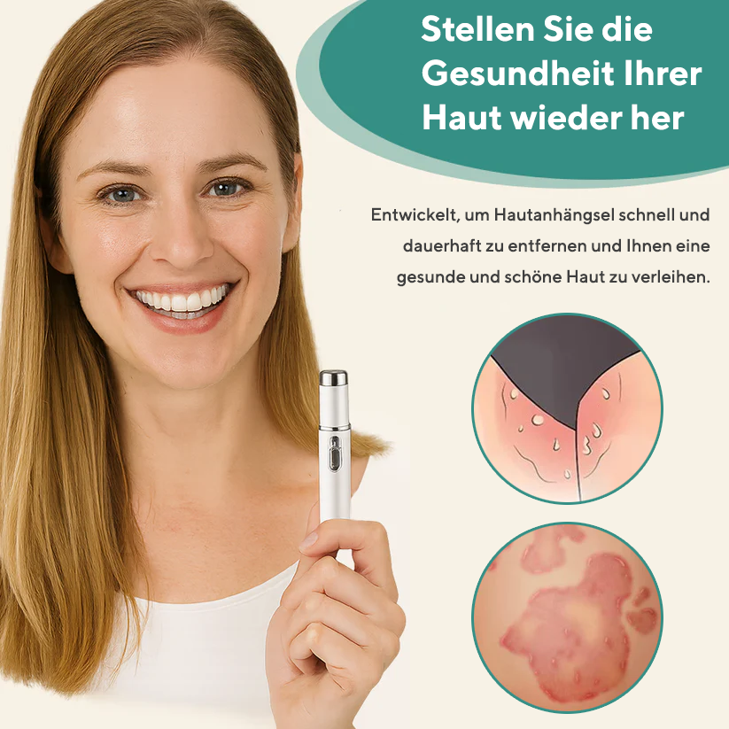 Bikenda® HPV Genitalwarzenentfernung Laserstift