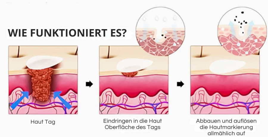 Oveallgo® Magnesium MicroPin Ziel & Klar Warzenentfernung Aufnäher