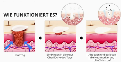 Oveallgo® Magnesium MicroPin Ziel & Klar Warzenentfernung Aufnäher