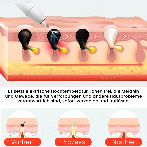 Fivfivgo™ Tragbarer Hautpflege-Laserstift