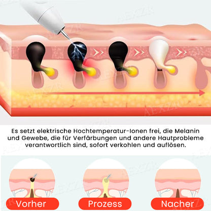 Fivfivgo™ Tragbarer Hautpflege-Laserstift