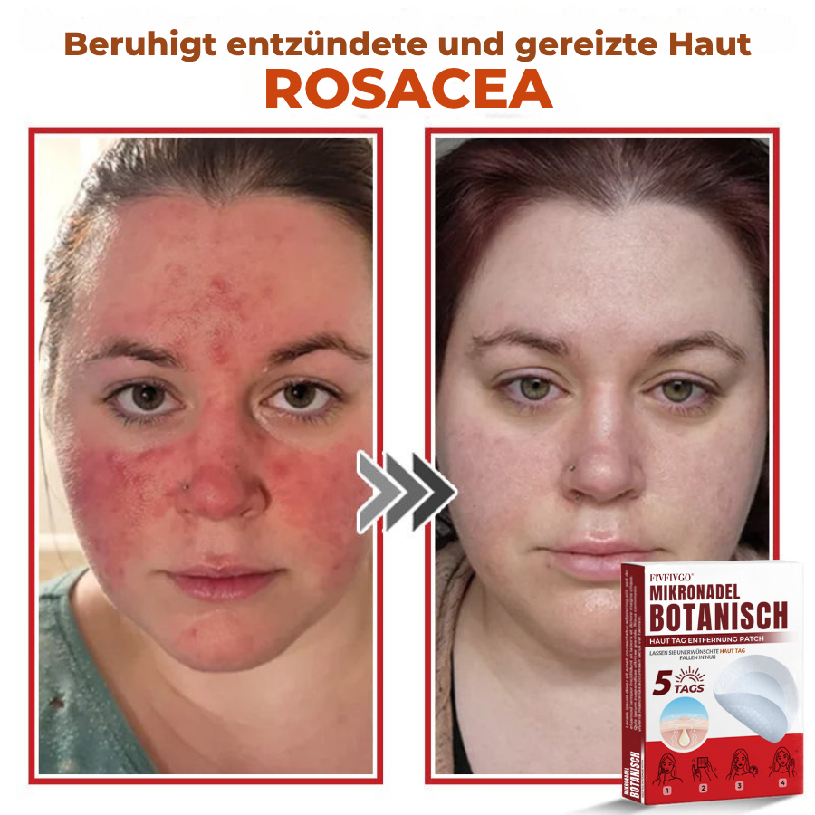 Fivfivgo® MikroNadel Botanisch Haut Tag Entfernung Patch 🇩🇪 Hergestellt in der Deutschland