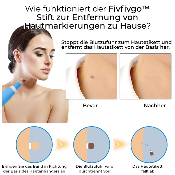 Fivfivgo™ Stift zur Entfernung von Hautmarkierungen zu Hause
