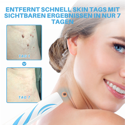 Fivfivgo® Schmerzfreier Stift zur Entfernung von Hautmarkierungen zu Hause