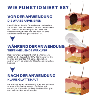 Fivfivgo® Mikronadel HPV Genitalien Warzen Entfernung Patch
