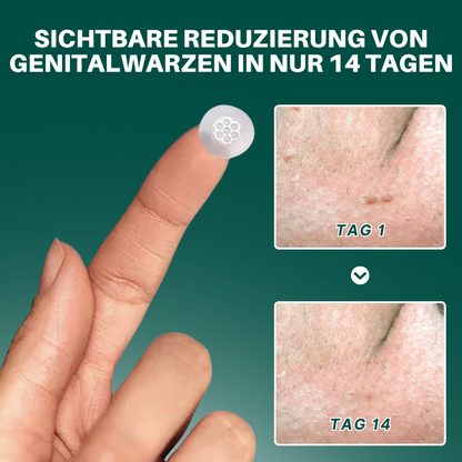 Fivfivgo® Magnesium Mikropin HPV Genitalien Warzen Entfernung Patch