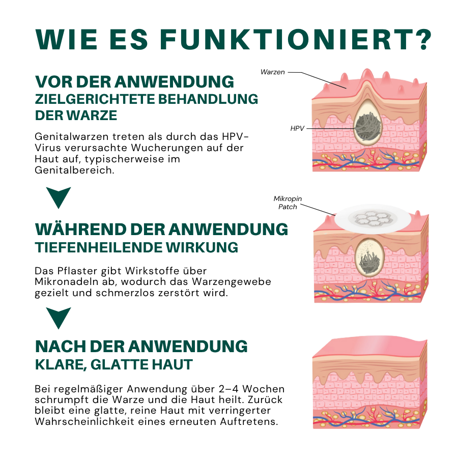 Fivfivgo® Magnesium Mikropin HPV Genitalien Warzen Entfernung Patch