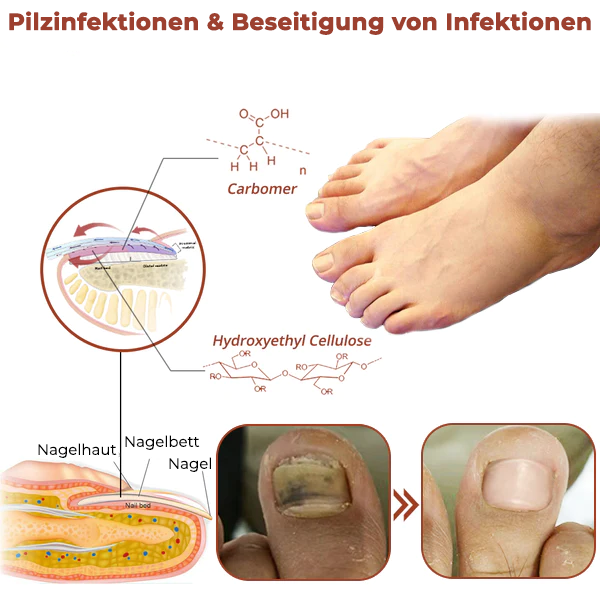 Fivfivgo™ Revolutionäres hocheffizientes Lichttherapiegerät für Zehennagelkrankheiten