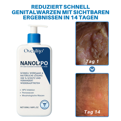Oveallgo® NanoLipo HPV Genital Warzen Radiergummi Creme