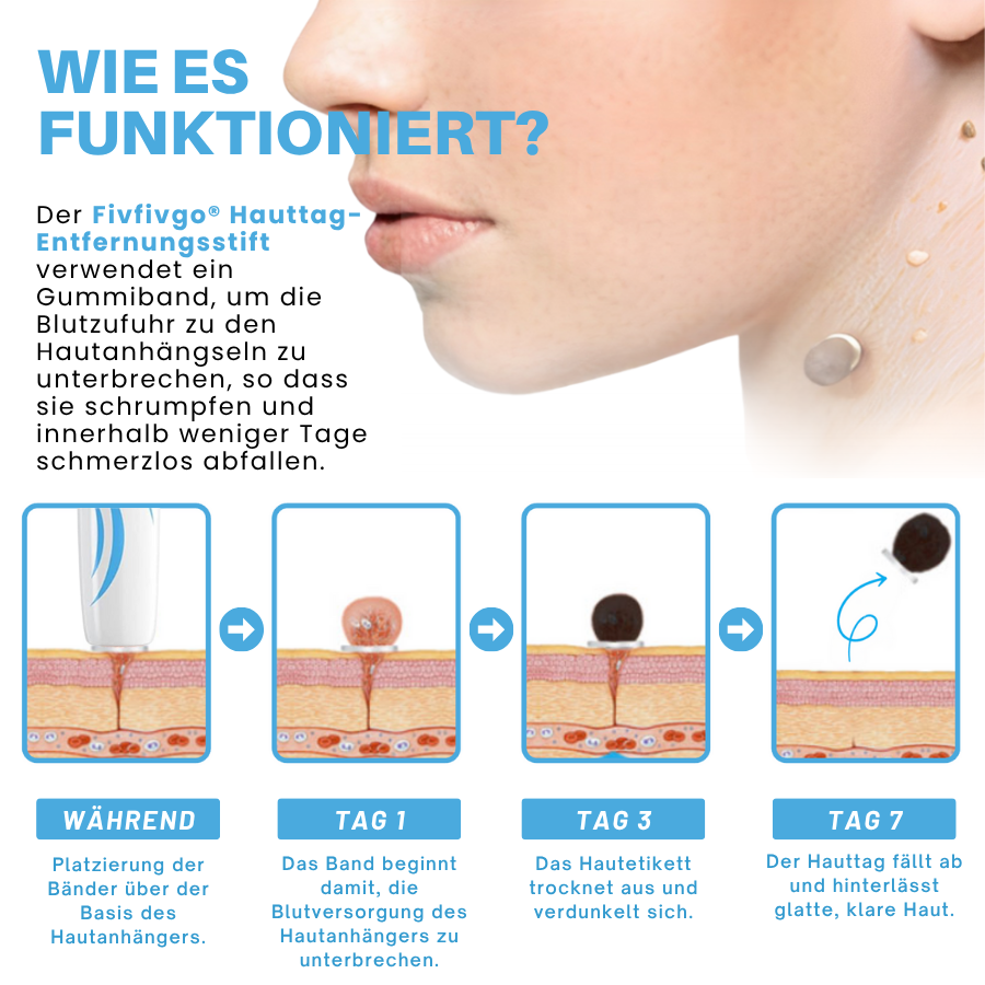 Fivfivgo® Schmerzfreier Stift zur Entfernung von Hautmarkierungen zu Hause