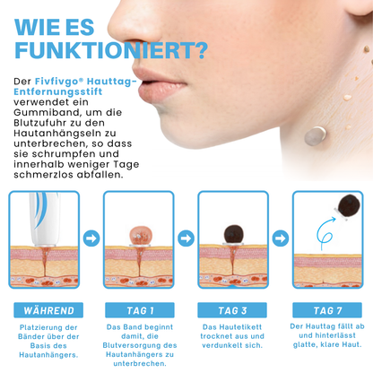 Fivfivgo® Schmerzfreier Stift zur Entfernung von Hautmarkierungen zu Hause