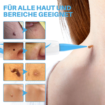 Fivfivgo® Schmerzfreier Stift zur Entfernung von Hautmarkierungen zu Hause