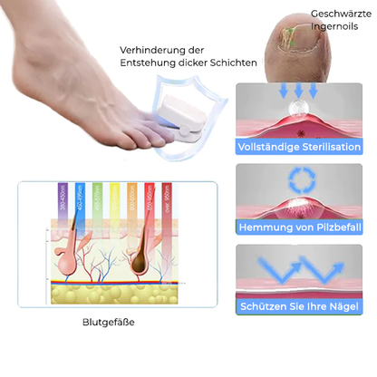 Fivfivgo™ Revolutionäres hocheffizientes Lichttherapiegerät für Zehennagelkrankheiten