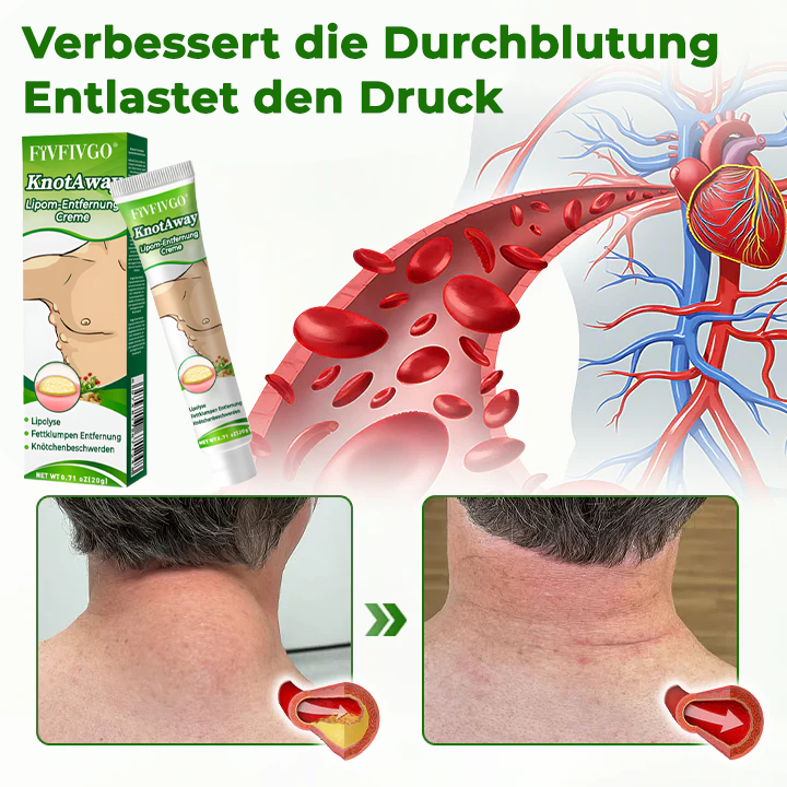 Fivfivgo® KnotAway Lipom-Entfernung Creme