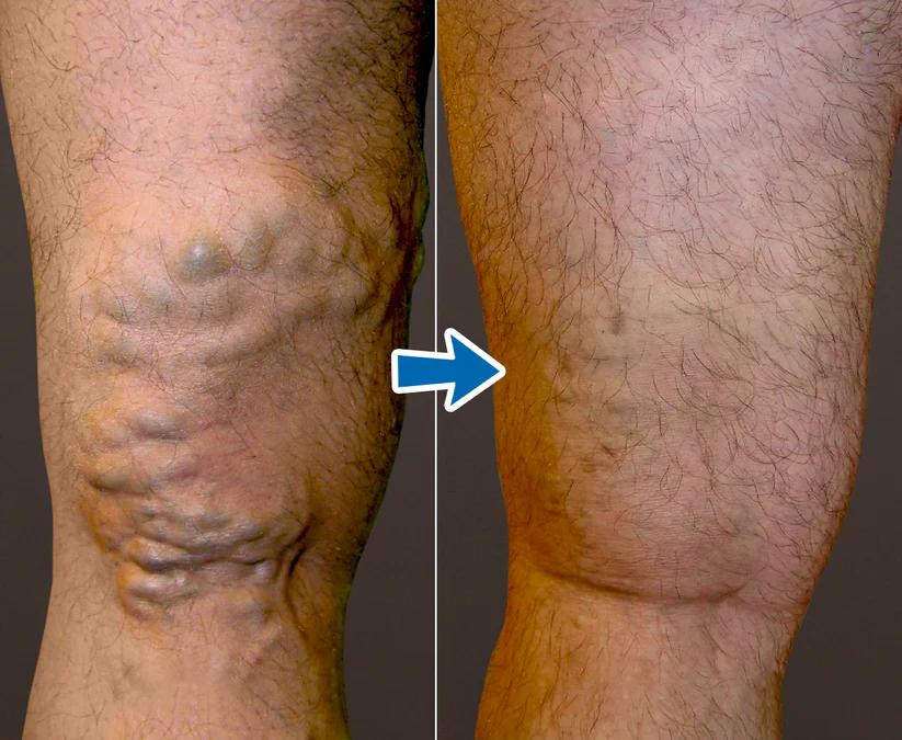 Cvreoz® VenoAid Varizen-Lösungsspray