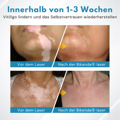 Bikenda® Vitiligo-Lichttherapiegerät