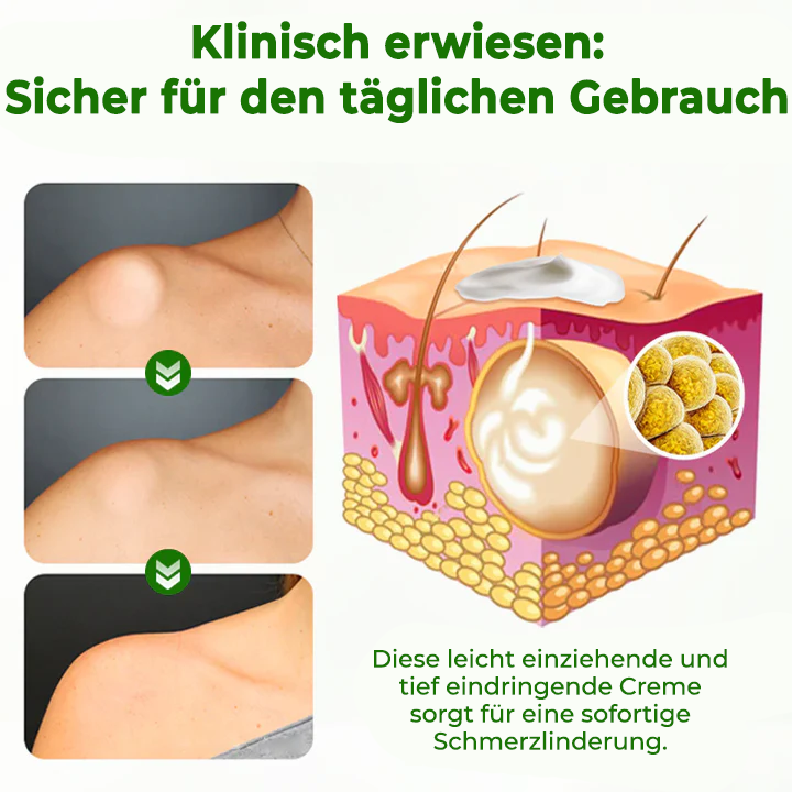Fivfivgo® KnotAway Lipom-Entfernung Creme