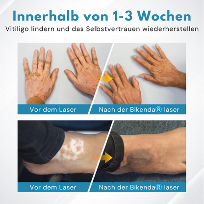 Bikenda® Vitiligo-Lichttherapiegerät