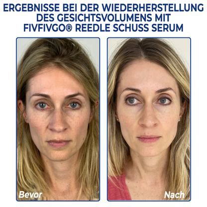 Fivfivgo® PDRN-NAD+ Cica Reedle Schuss Serum