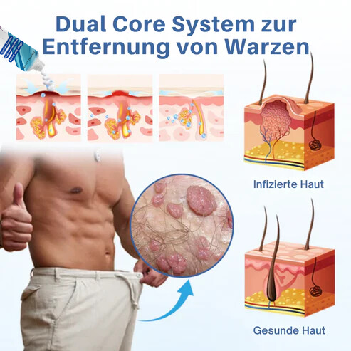 Oveallgo® GentX Warzenentlastungs Creme