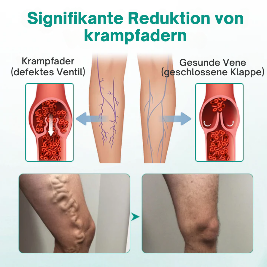 Cvreoz® LegRenew Krampfadern-Patch