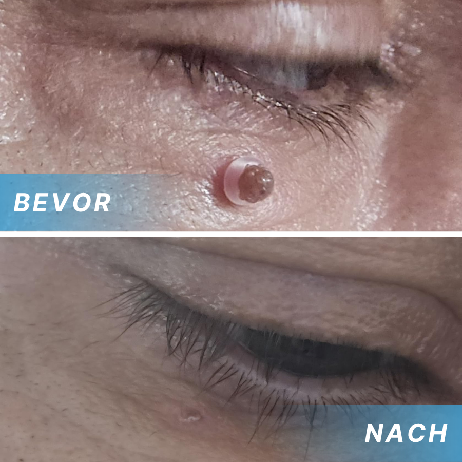 Fivfivgo® Schmerzfreier Stift zur Entfernung von Hautmarkierungen zu Hause