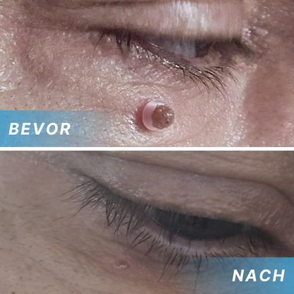 Fivfivgo® Schmerzfreier Stift zur Entfernung von Hautmarkierungen zu Hause