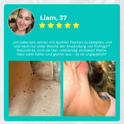 Fivfivgo® NatureErase Sofortige Maulwurf- und Fleckencreme
