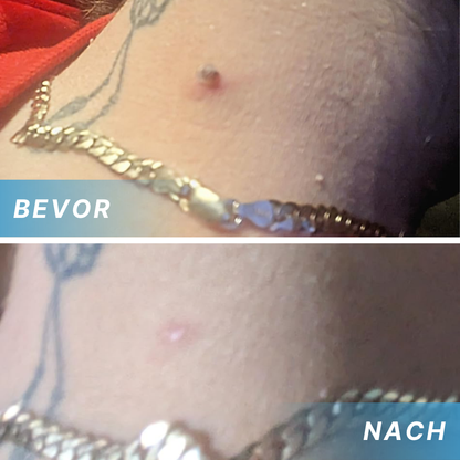 Fivfivgo® Schmerzfreier Stift zur Entfernung von Hautmarkierungen zu Hause