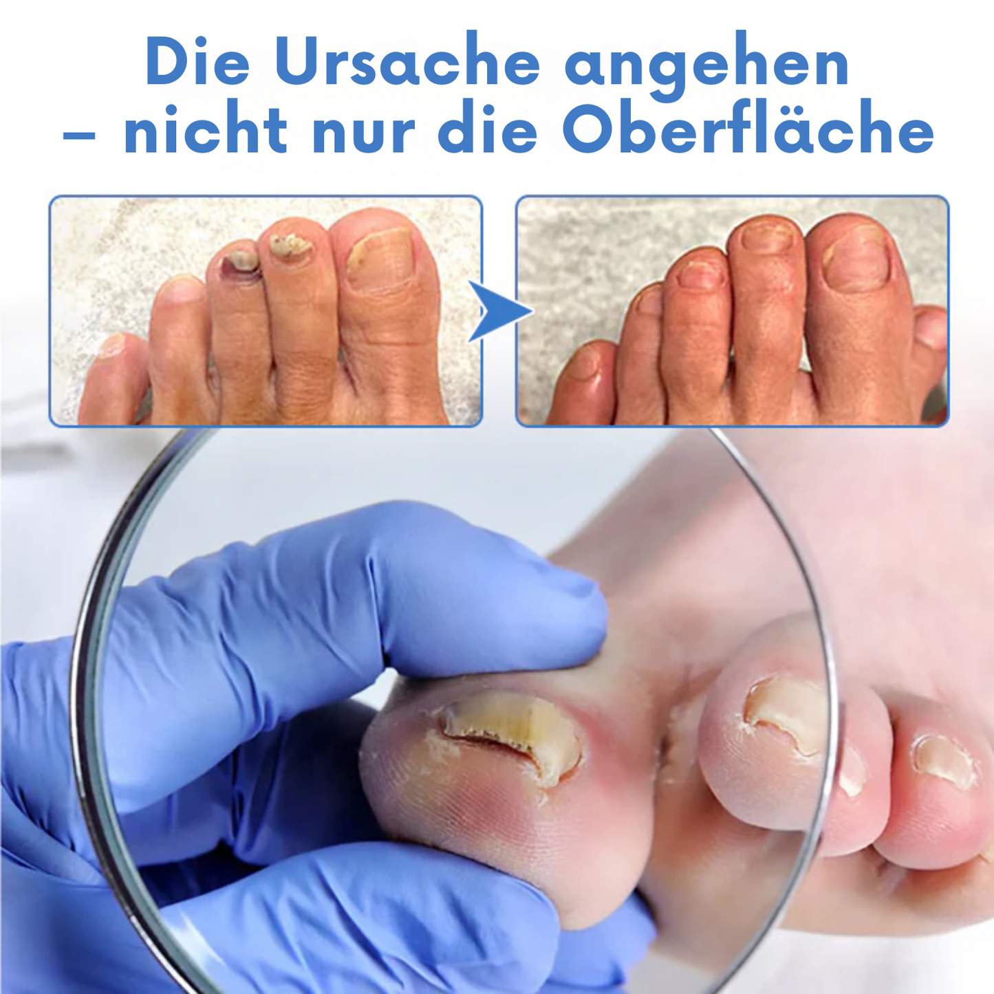 Fivfivgo® MycoErase Nagel Stift Wiederbeleben