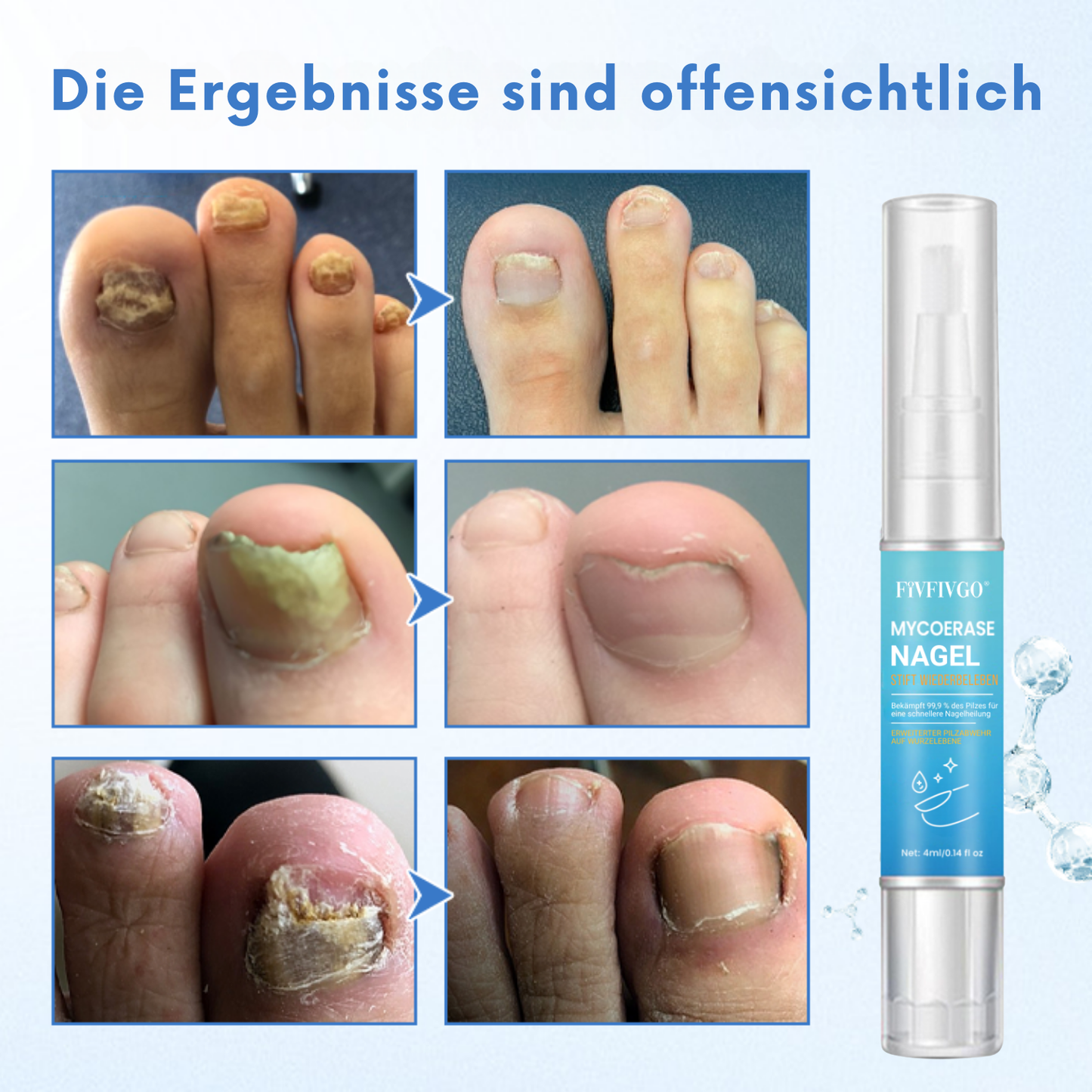 Fivfivgo® MycoErase Nagel Stift Wiederbeleben