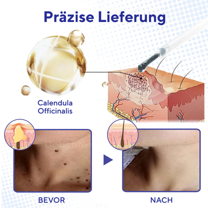 Fivfivgo® Warzen-Entferner Pro