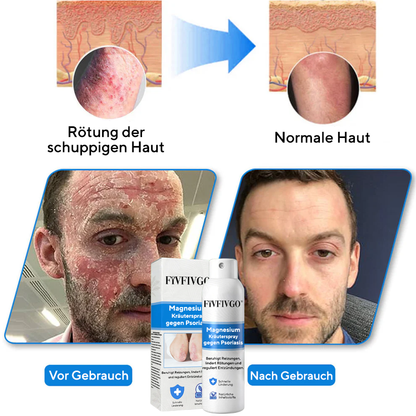 Fivfivgo® Magnesium-Kräuterspray gegen Psoriasis