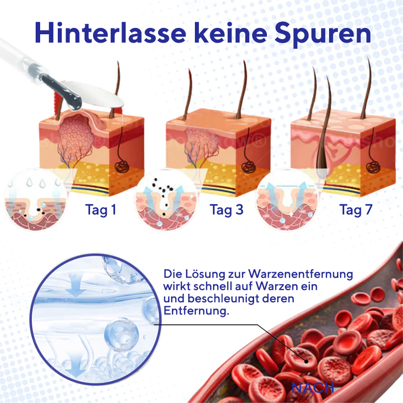 Fivfivgo® Warzen-Entferner Pro