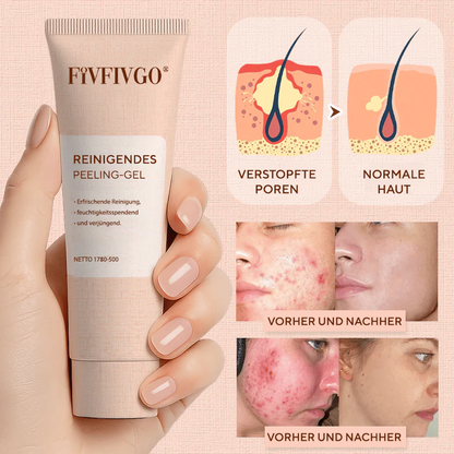 Fivfivgo® Reinigendes Peeling-Gel für Acanthosis Nigricans, Peeling, dunkle Flecken, Hautflecken und Ekzeme