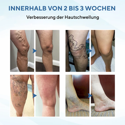 NovaRX® TheraVein Kräuterspray gegen Krampfadern