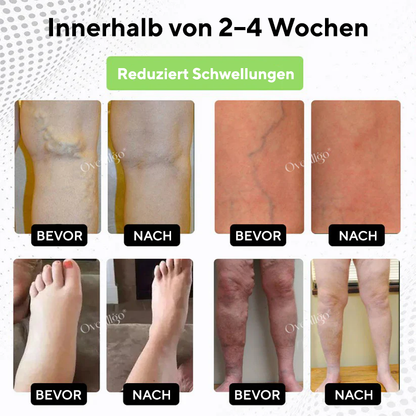 Oveallgo® CircuPro Inhalator zur Unterstützung bei Ödemen und Lymphproblemen