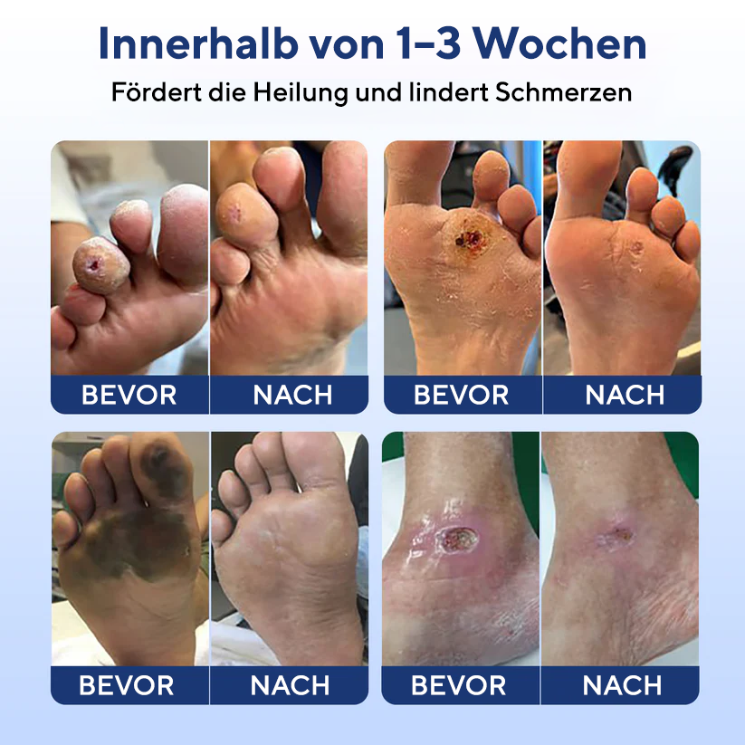 Cvreoz® UltraHeal Fußcreme für Diabetiker