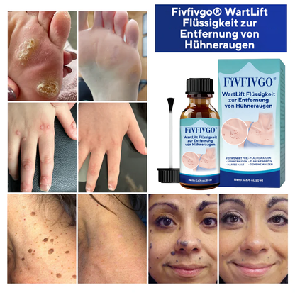 Fivfivgo® WartLift Flüssigkeit zur Entfernung von Hühneraugen