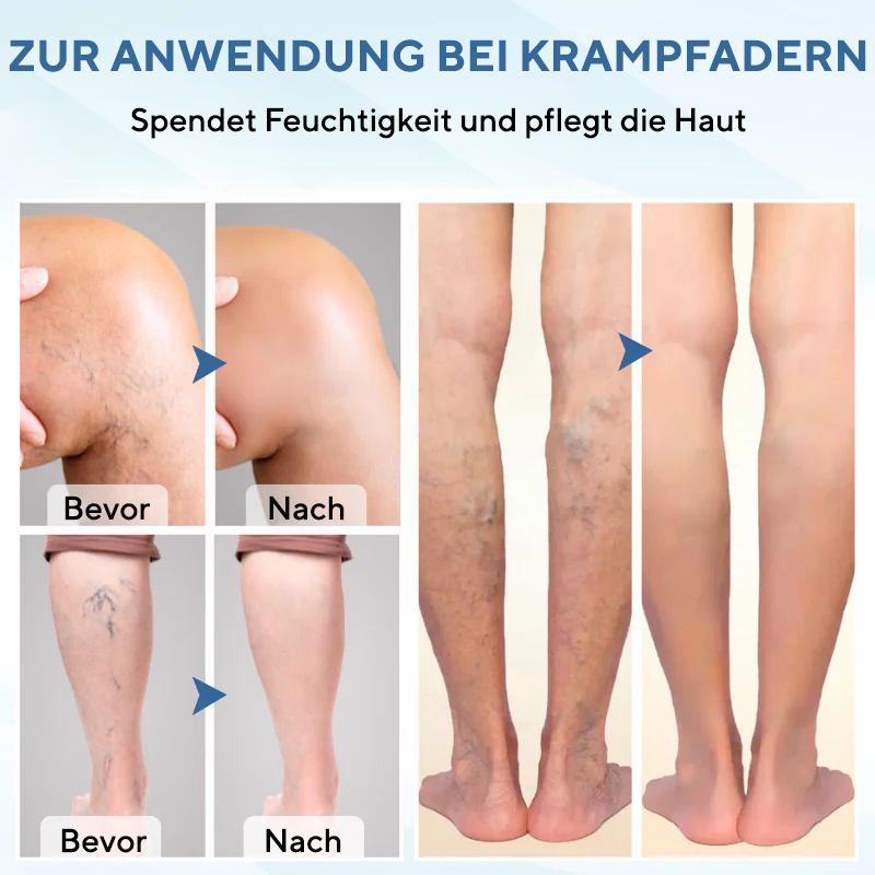 NovaRX® TheraVein Kräuterspray gegen Krampfadern