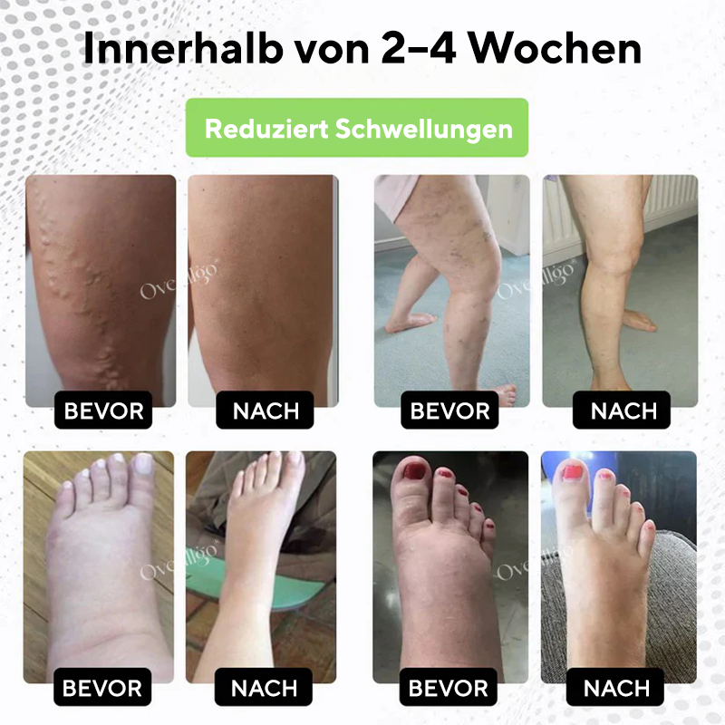 Oveallgo® CircuPro Inhalator zur Unterstützung bei Ödemen und Lymphproblemen