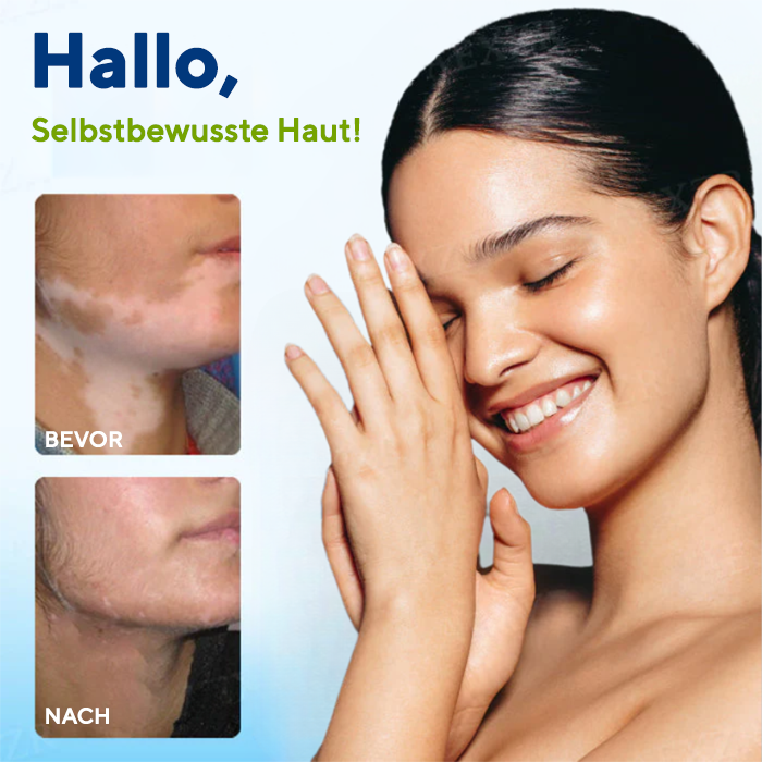 Fivfivgo® Vitiligo Behandlung Spray