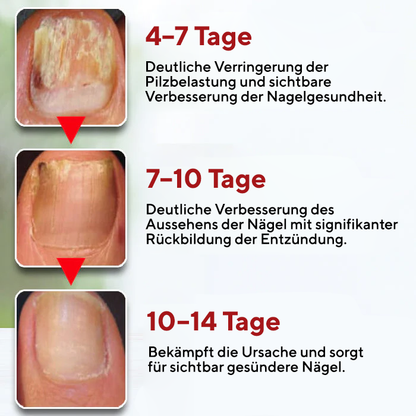 Fivfivgo® Pilz-Heilmittel Max – Schnell wirkende Linderung bei Nagelpilzinfektionen