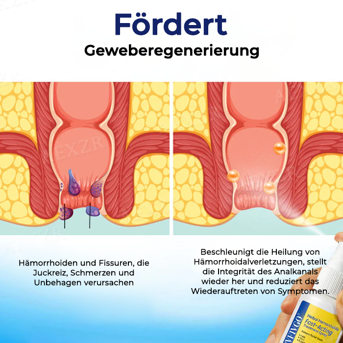 Fivfivgo® Pflanzliches Hämorrhoiden Schnellwirkendes Behandlungsspray