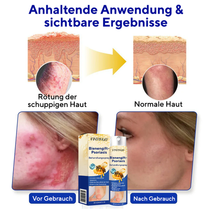 Fivfivgo® Bienengift-Psoriasis-Behandlungsspray
