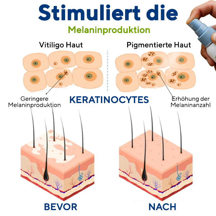 Fivfivgo® Vitiligo Behandlung Spray
