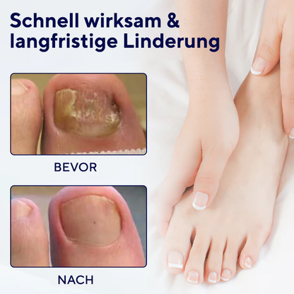 Fivfivgo® Antimykotisches Nagelreparaturpflaster