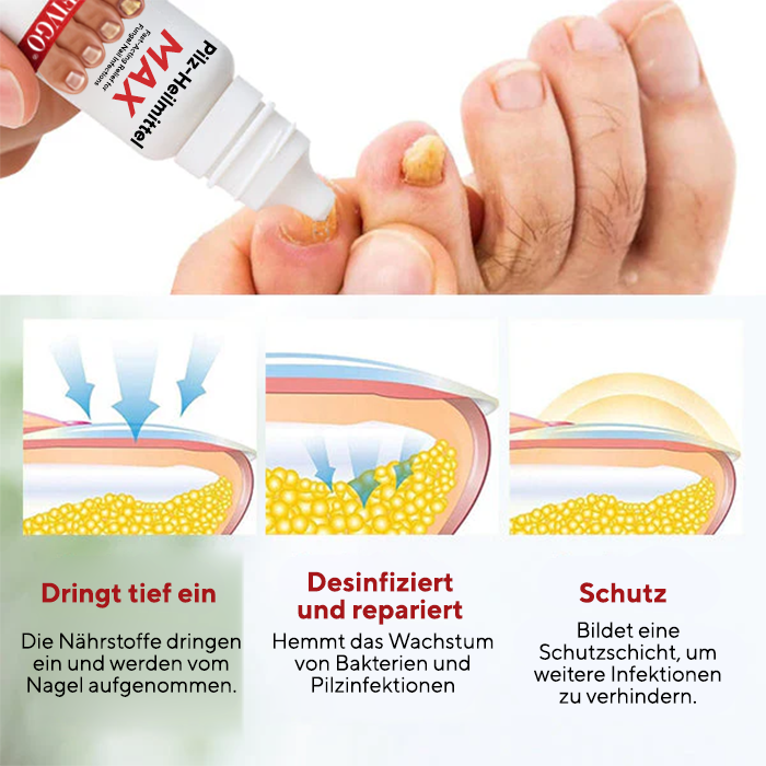 Fivfivgo® Pilz-Heilmittel Max – Schnell wirkende Linderung bei Nagelpilzinfektionen